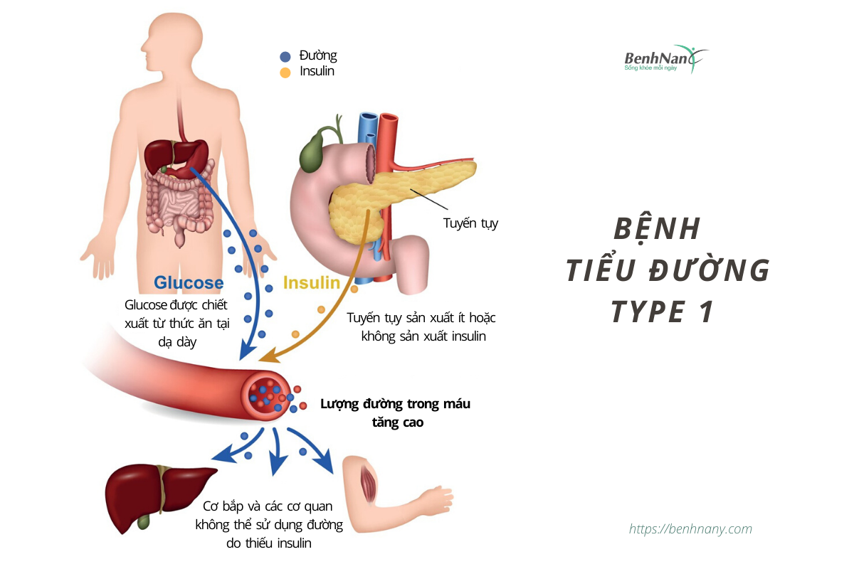 Bệnh tiểu đường là gì? Cách phòng bệnh tiểu đường hiệu quả 2 Benh tieu duong tuyp 1 1