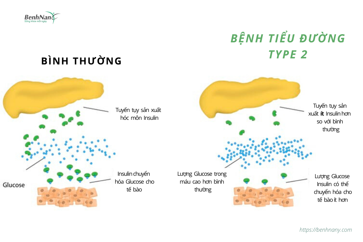 Bệnh tiểu đường là gì? Cách phòng bệnh tiểu đường hiệu quả 3 Benh tieu duong tuyp 2 1