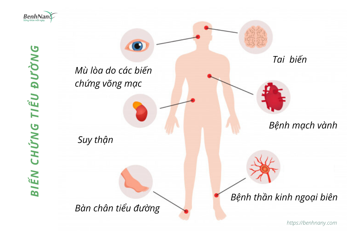 Bệnh tiểu đường là gì? Cách phòng bệnh tiểu đường hiệu quả 5 Benhnany