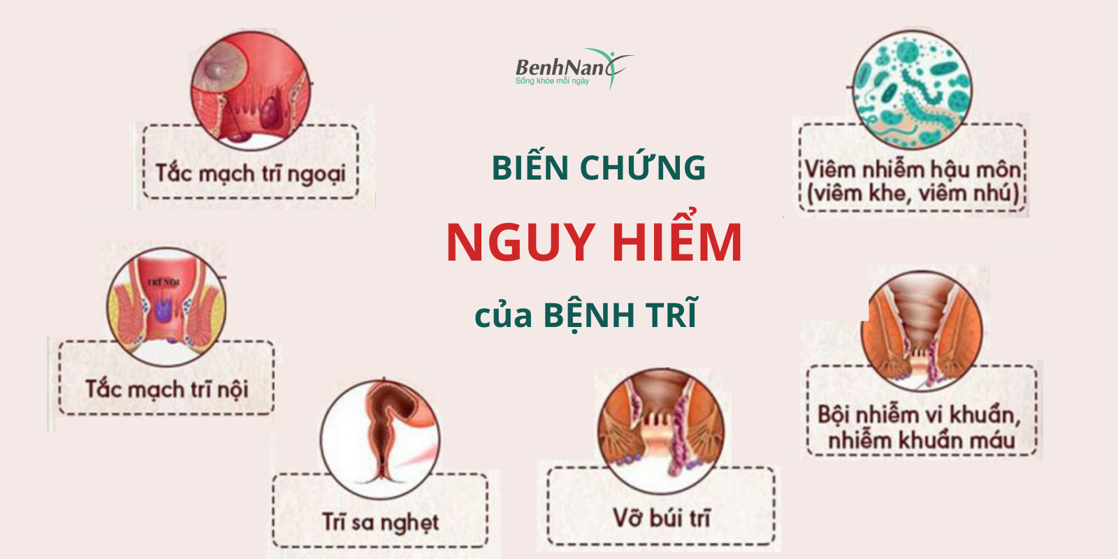 Bệnh trĩ: Nguyên nhân, triệu chứng, cách phòng ngừa và điều trị bệnh 4 Bien chung benh tri