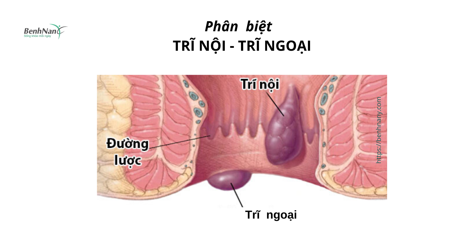 Bệnh trĩ: Nguyên nhân, triệu chứng, cách phòng ngừa và điều trị bệnh 1 Phan biet tri noi tri ngoai