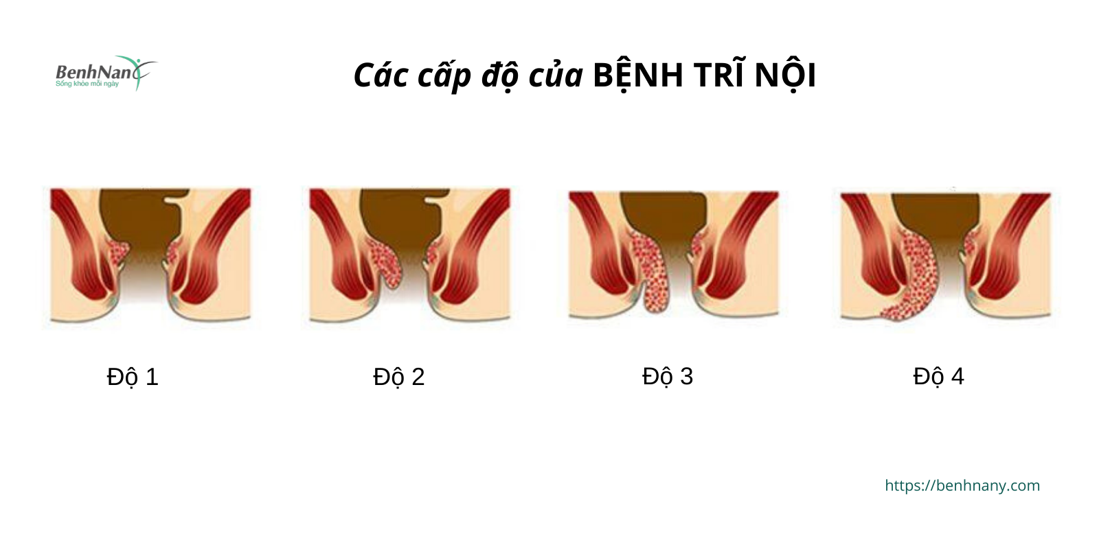 Tri noi co cac cap do nao