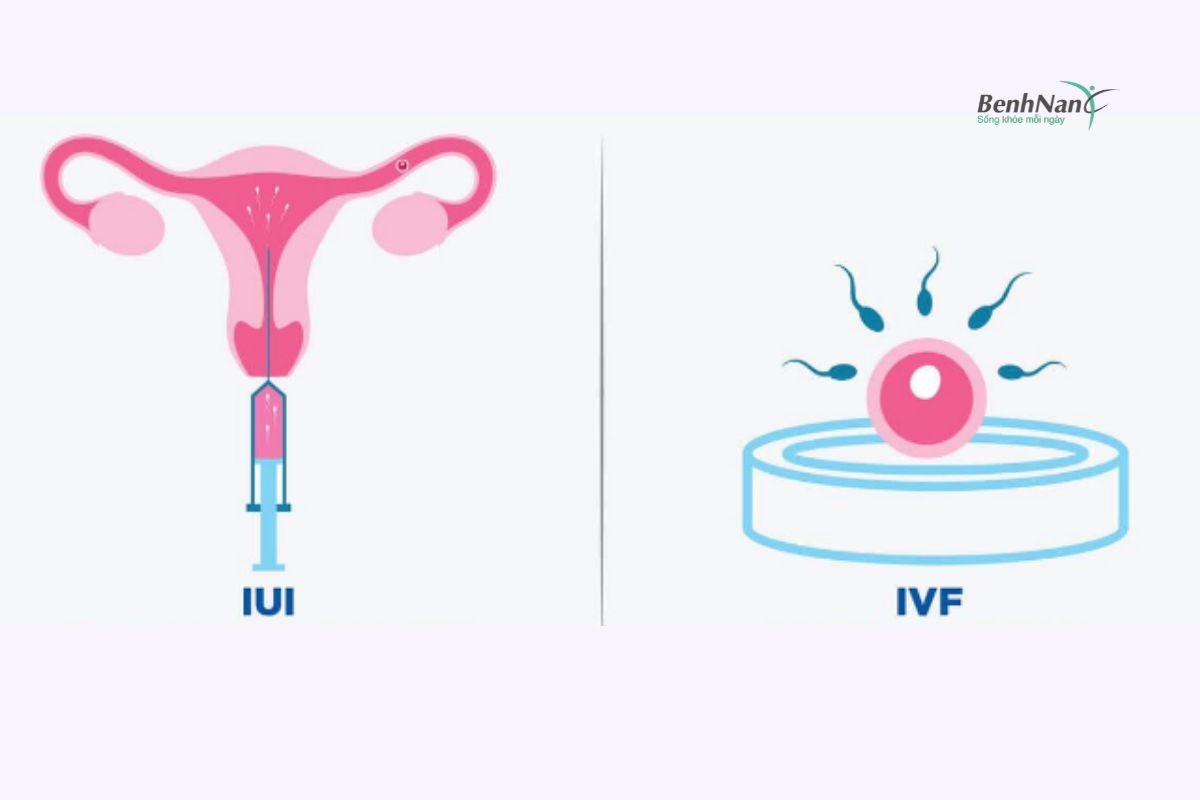 Các biện pháp điều trị vô sinh hiếm muộn ở nam giới