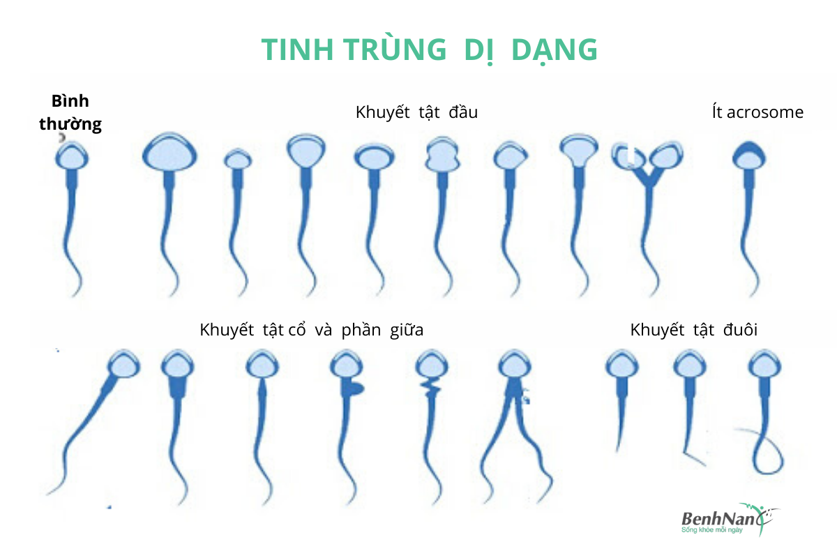 Tinh trùng dị dạng phải làm gì