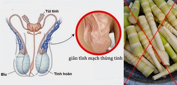 Nam giới bị giãn tĩnh mạch thừng tinh nên hạn chế ăn măng