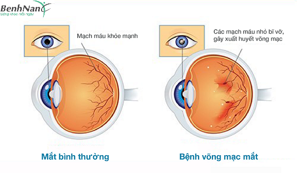 Tiểu đường bị mờ mắt