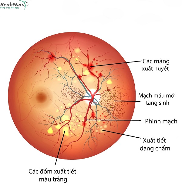 Tiểu đường gây mờ mắt
