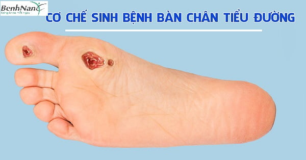 Mách bạn 10 cách chăm sóc bàn chân cho người tiểu đường 1 Cơ chế sinh bệnh bàn chân tiểu đường