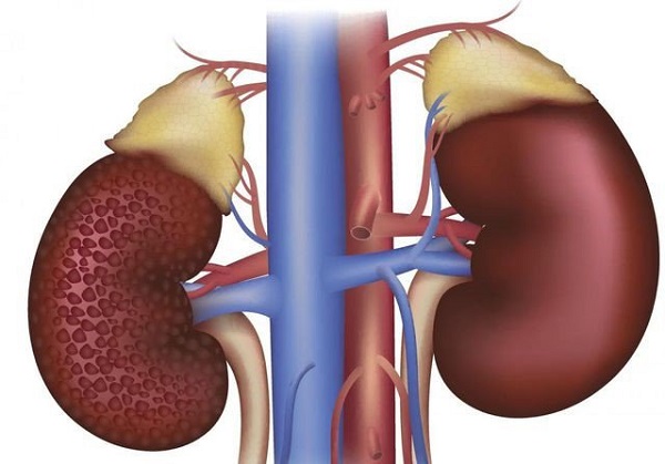 Biến chứng thận của bệnh tiểu đường: Nguyên nhân, dấu hiệu, cách phòng ngừa 1 Bệnh tiểu đường gây biến chứng trên thận vì sao?