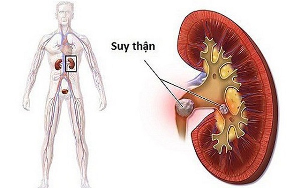 Biến chứng thận của bệnh tiểu đường: Nguyên nhân, dấu hiệu, cách phòng ngừa 3 Cách phòng ngừa biến chứng thận cho người tiểu đường