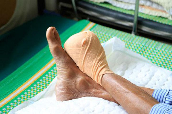 Phuơng pháp phòng ngừa và điều trị loét bàn chân tiểu đường 2 Các mức độ loét bàn chân tiểu đường