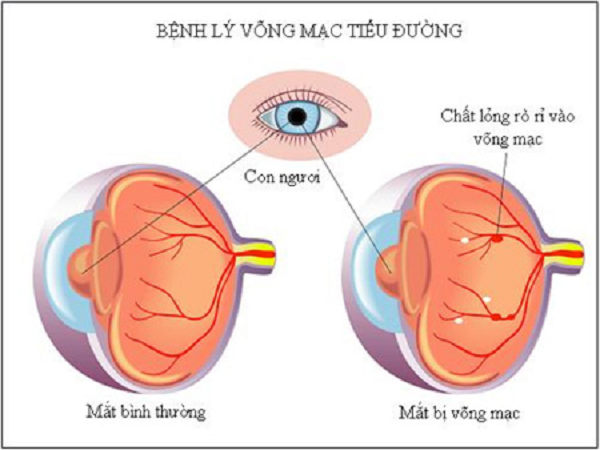 Mờ mắt do biến chứng tiểu đường: Nguyên nhân, cách phòng tránh hiệu quả 2 Mờ mắt do biến chứng tiểu đường: Bệnh lý võng mạc tiểu đường