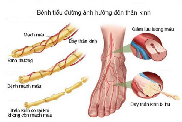 Biến chứng thần kinh tiểu đường: Nguyên nhân, dấu hiệu, cách phòng tránh 1 Biến chứng thần kinh do bệnh tiểu đường gây ra