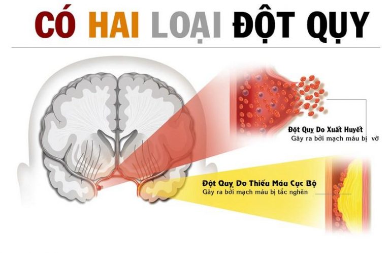 Bệnh tiểu đường và đột quỵ có mối quan hệ như thế nào? 1 Đột quỵ là gì?