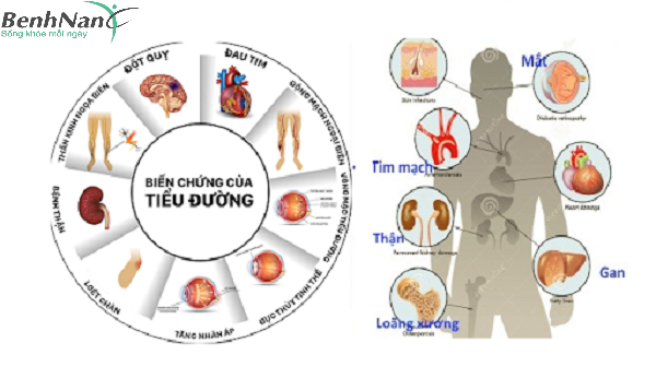 Thời gian biến chứng của bệnh tiểu đường khoảng bao lâu? 2 Những biến chứng phổ biến nhất của bệnh tiểu đường
