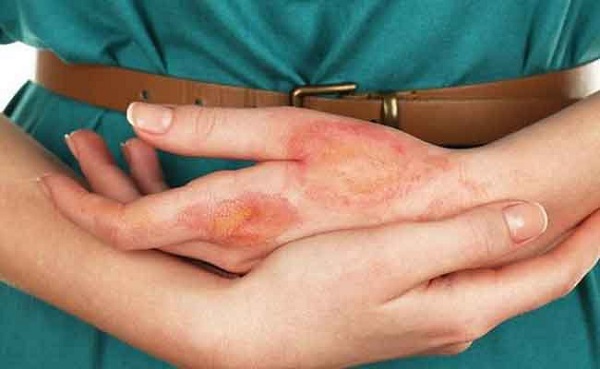 Bệnh tiểu đường gây ngứa: Nguyên nhân và cách khắc phục 1 Nguyên nhân bệnh tiểu đường gây ngứa