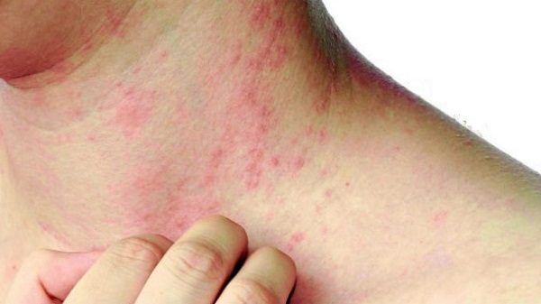 Bệnh tiểu đường gây ngứa: Nguyên nhân và cách khắc phục 3 Hạn chế những ảnh hưởng của ngứa do bệnh tiểu đường