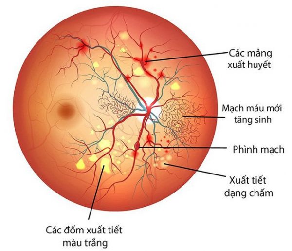 Triệu chứng bệnh võng mạc tiểu đường