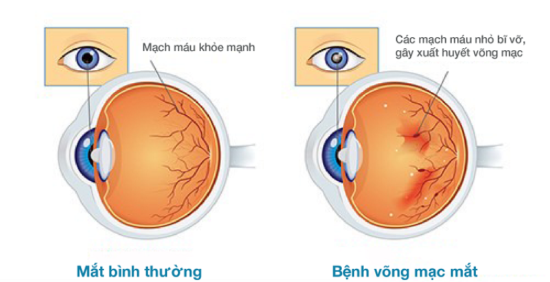 Bệnh võng mạc tiểu đường là gì?