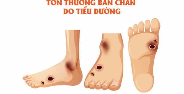 bien chung tieu duong o chan 34784371