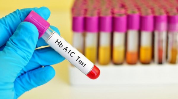 Những tiêu chuẩn chẩn đoán bệnh tiểu đường tuýp 1 2 Chẩn đoán tiểu đường tuýp 1