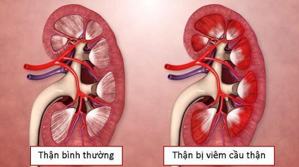 Các bài thuốc chữa viêm cầu thận và sỏi thận hiệu quả 1 Chữa viêm cầu thận cấp do phê khí không thông