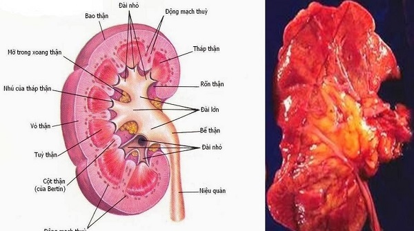 Các bài thuốc chữa viêm cầu thận và sỏi thận hiệu quả 2 Chữa viêm cầu thận cấp do nhiệt thấp