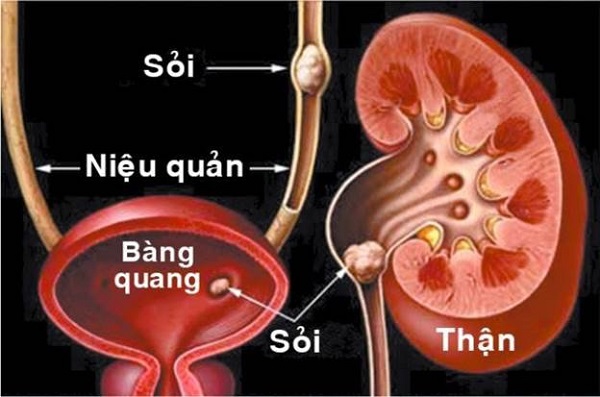 Tổng hợp các bài thuốc chữa bệnh về tiểu tiện hiệu quả 3 Chữa viêm đường tiết liệu (đái dắt và buốt)
