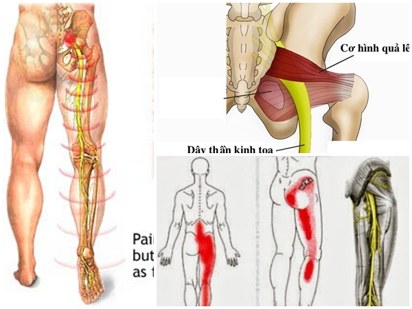 Đau dây thần kinh hông