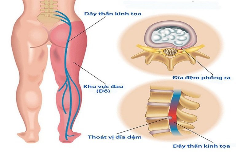 Đau dây thần kinh hông, nguyên nhân và cách chữa như thế nào? 3 Cách phòng chống bệnh đau dây thần kinh hông?