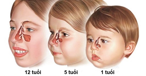 Biện pháp xử lý viêm xoang đơn giản tại nhà hiệu quả 2 Biện pháp xử lý viêm xoang sàng cấp ở trẻ em: