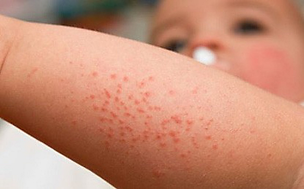 Một số bài thuốc y học góp phần chữa bệnh sốt xuất huyết 1 Bệnh sốt xuất huyết