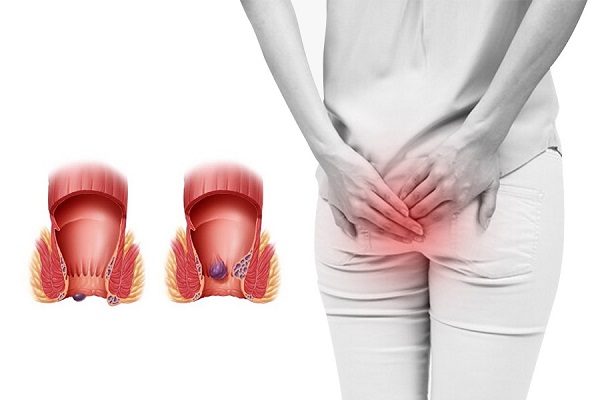 Lưu ý khi chữa bệnh trĩ bằng bấm huyệt